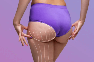 woman's backside with illustrated cellulite